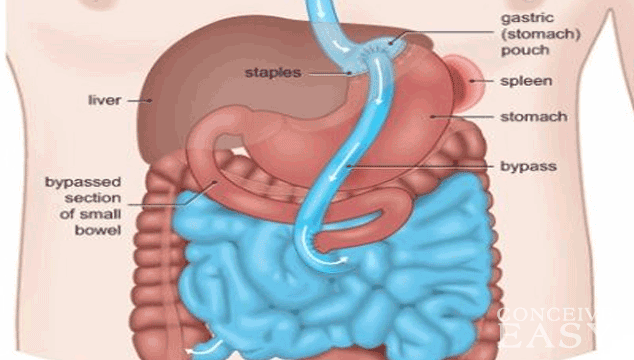 trouble-getting-pregnant-after-gastric-bypass-conceiveeasy