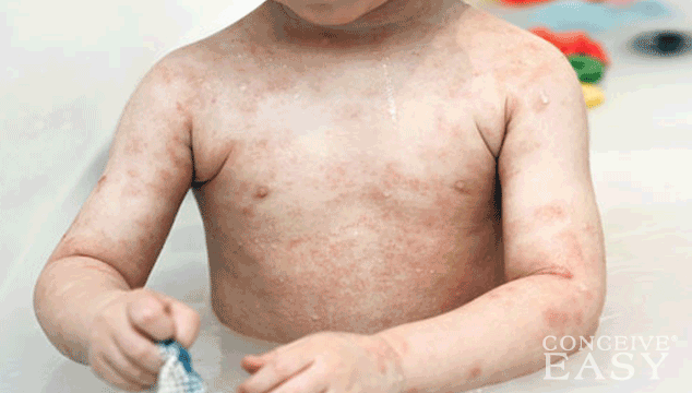 how-to-treat-children-s-skin-rashes-conceiveeasy