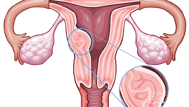 can-i-get-pregnant-with-submucosal-fibroid-conceiveeasy